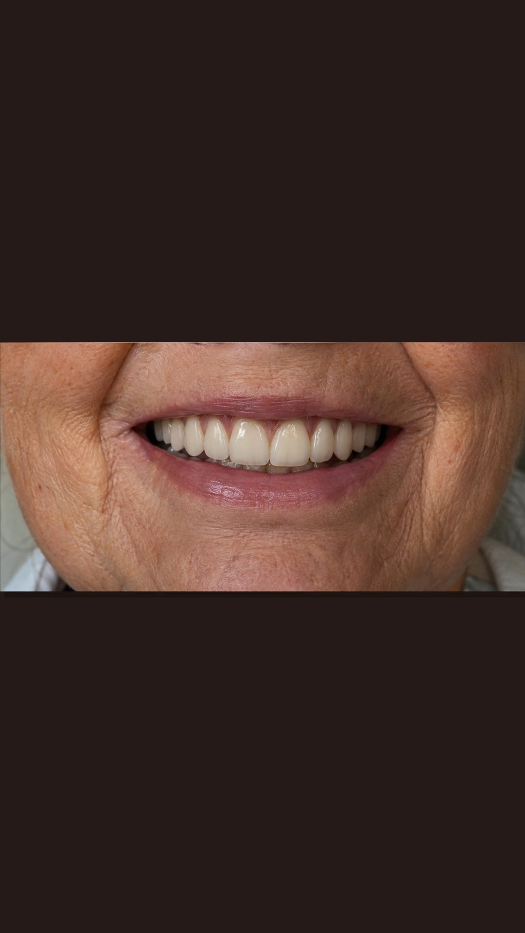 Risultato finale della riabilitazione
